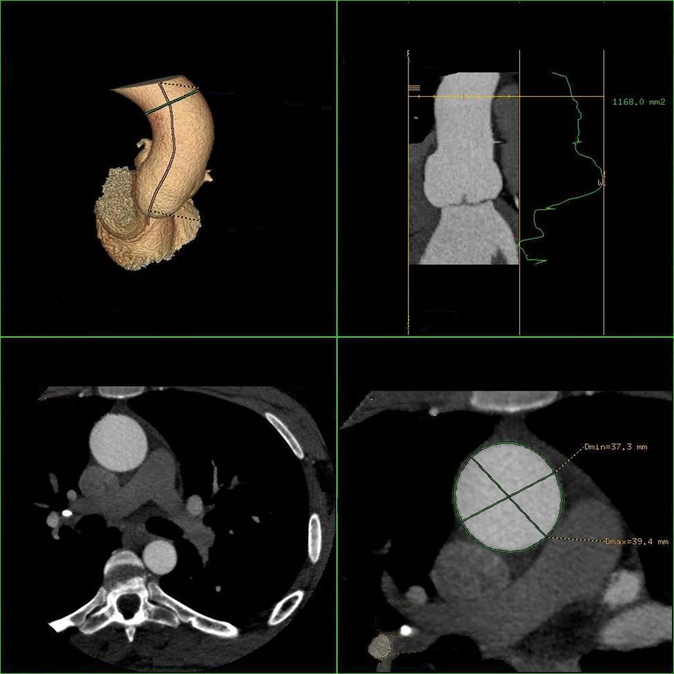 Index Patient : CTA imaging 3D Reformations, Axial, Oblique views, C+, CTA Ascending aorta; level of right pulmonary artery