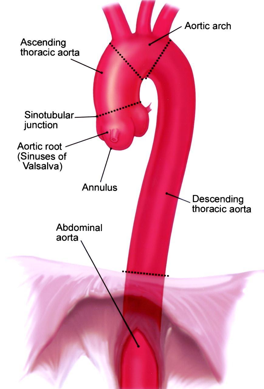 60% Anatomy of the thoracic aorta and classification 10% 40% 10% Aneurysm of the thoracic aorta can be classified into four anatomical categories Ascending aortic Aortic arch Descending aortic