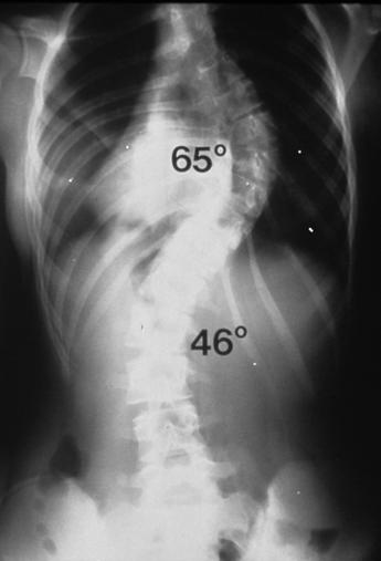 PATIENT EVALUATION History and Physical Examination Adolescents may present for evaluation of a spinal deformity in a wide variety of ways.