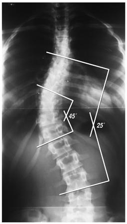 The Adam's forward bend test is considered a standard in the examination for scoliosis.