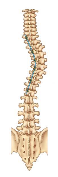 Surgery Spinal surgery is recommended for mature adolescents with large curves that are likely to progress in adulthood.