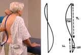 2005; 9 Voutsinas, 1986 Kyphosis Cobb Angle (degrees)) 61 59 57 55 53 51 49 47 Kyphosis Progression in Older Women Over 15 Years With prevalent vertebral fracture Mean Trajectory Without prevalent