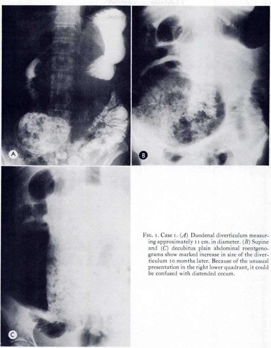 VOL. 121, No. 2 Giant Duodenal Diverticula 335 r - -- small bowel obstruction from pressure phenomena, hemorrhage from ulceration,9 perforation and fistula formation.