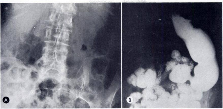 VOL. 12!, No. 2 Giant Duodenal Diverticula 337 FIG. 4. Case iv. (A) Multiloculated gas-filled collection in the right mid-abdominal region.