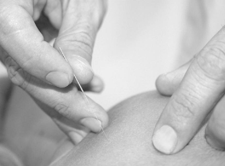 OBJECTIVES To provide professional physiotherapists with: A needle to be used for DRY NEEDLING Highest quality and