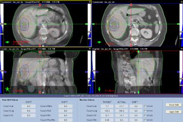 Planning CT and On-Board CBCT Image Fusion Manual Skill and