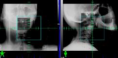 Radiographic Imaging Options Orthogonal radiograph Cone-Beam CT
