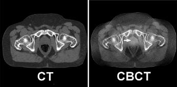 Imaging: On-board Cone-Beam CT (CBCT) 0 o On-Board H & N DTS Imaging