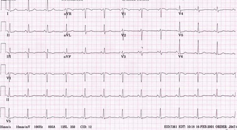 Intervals Normal 12 Lead ECG ST PR AV nodal conduction 100-200ms QT Repolarization ~350-400ms QRS ventricular activation 90-120ms Rate and Intervals Heart Rate 0.2 sec 0.