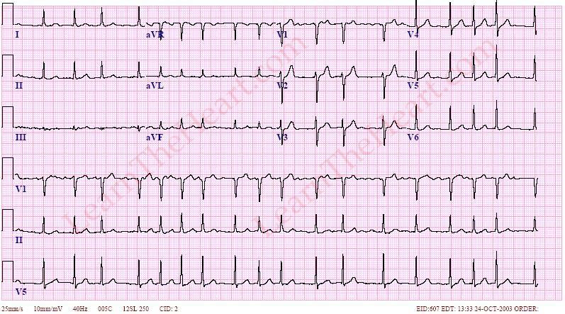 position of the lead Rhythm P waves Represents atrial electrical activity If marching in front of QRS waves,