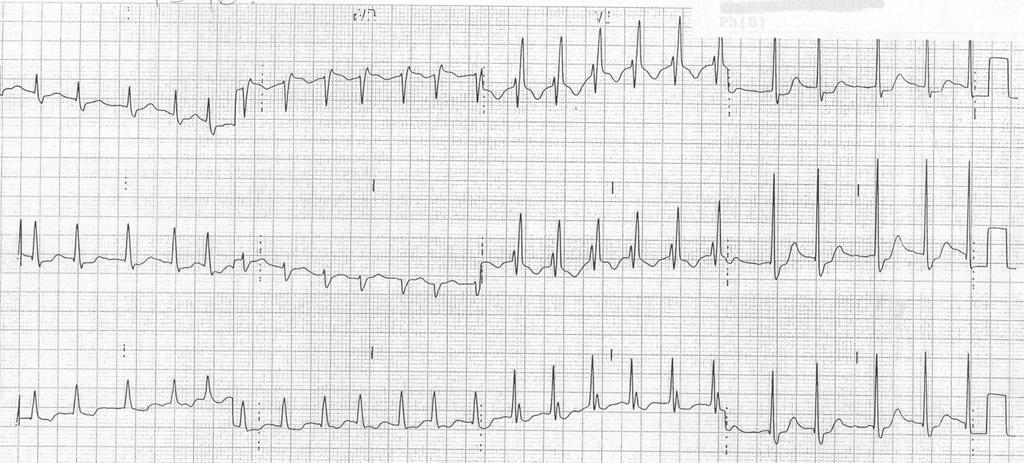 Right Bundle Branch Block Rabbit ears in V1 or V2 a double peak in the R complex in V1 or V2 caused