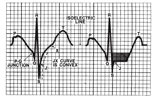 ST segment changes during Exercise ECG 2 mm ST segment depression A. Normal B. Upsloping ST segment depression returns to baseline within 80ms C. Upsloping ST segment depression > 1.