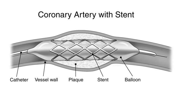 What is a Percutaneous Coronary Intervention (PCI)? (continued) What Can I Expect BEFORE the Procedure?
