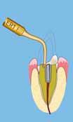 endo revision instruments endo revision with ER instruments Exposure and
