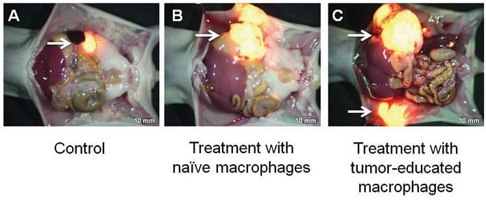 Menen et al: Tumor-educated Macrophages in Pancreatic Cancer Figure 2.