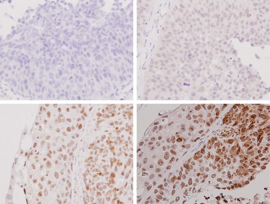 Nomura et al. BMC Urology 23, 3:73 Page 3 of 6 2 3 Figure Sample immunohistochemical images of Snail staining in bladder cancer. Snail expression scores by immunohistochemistry.