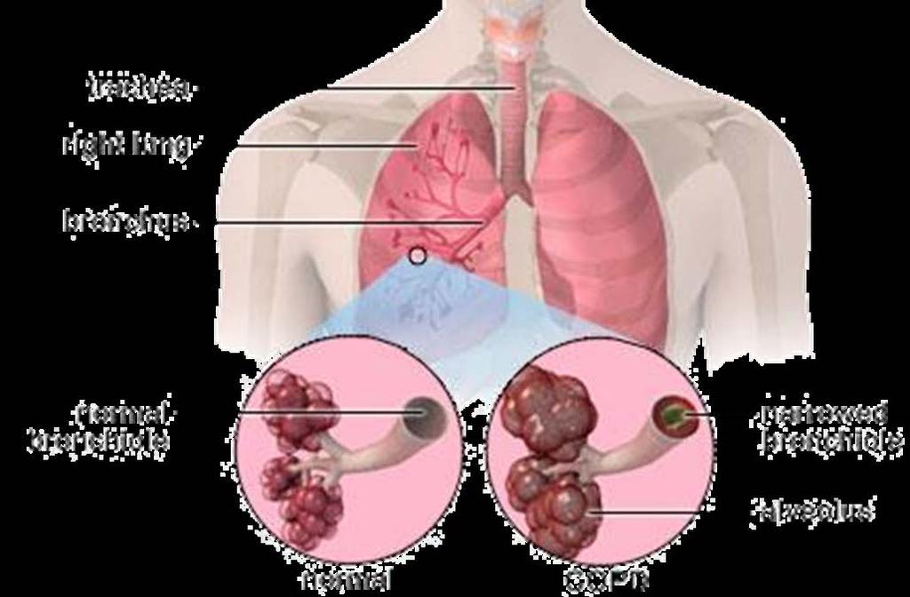 Case Study: Chronic Obstructive Pulmonary Disease COPD refers to lung diseases that block airflow.