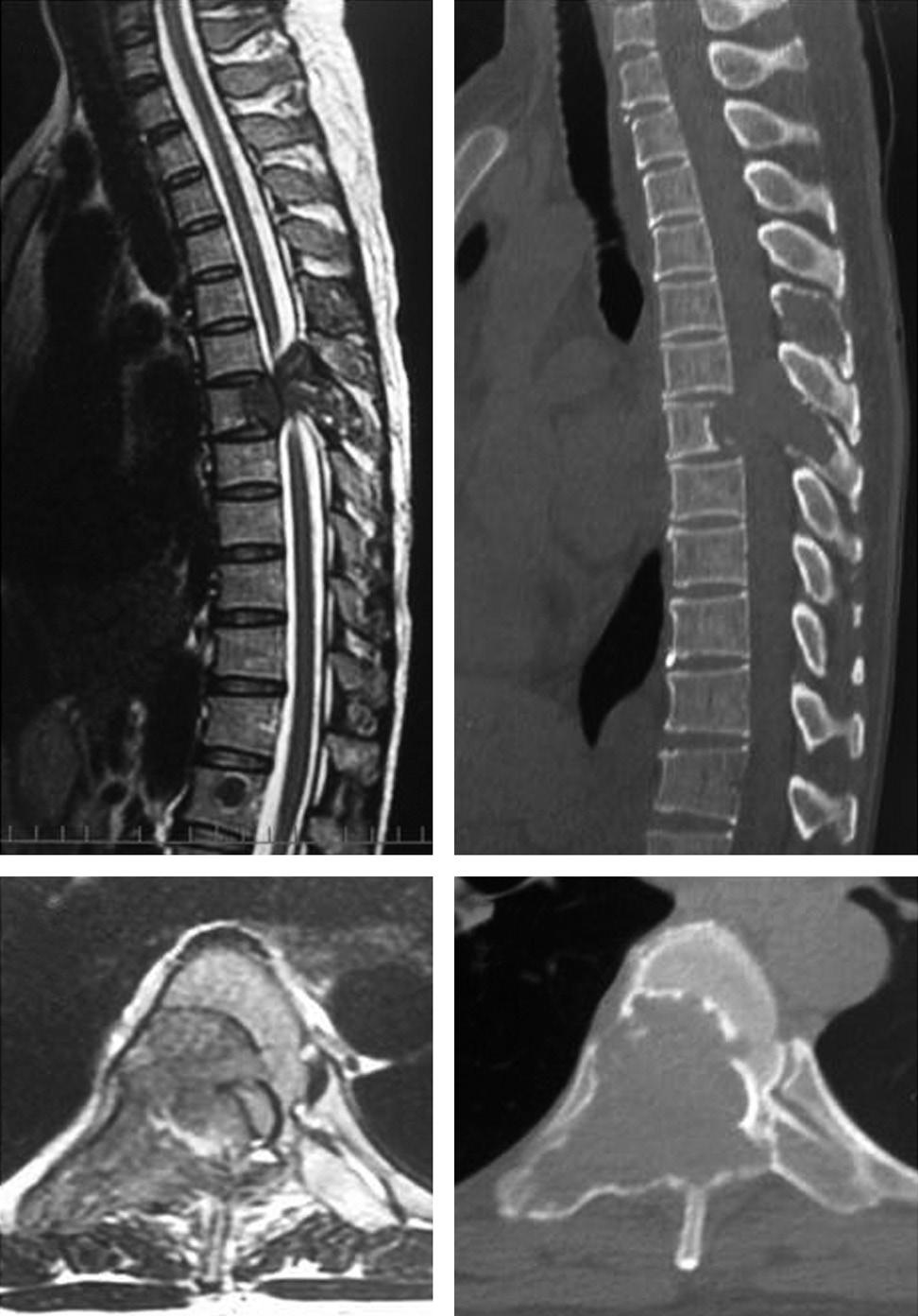 282 Kazuyoshi Kobayashi et al. Asian Spine J 2015;9(2):281-285 Case Report At 39-years-of-age, a woman was incidentally diagnosed with struma ovarii after a surgical procedure for ovarian torsion.