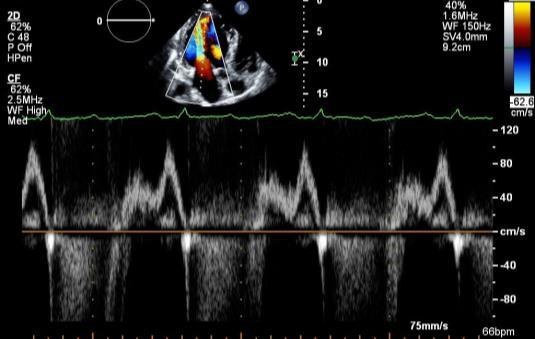 67 yo man with ischemic CM and HF Gr.