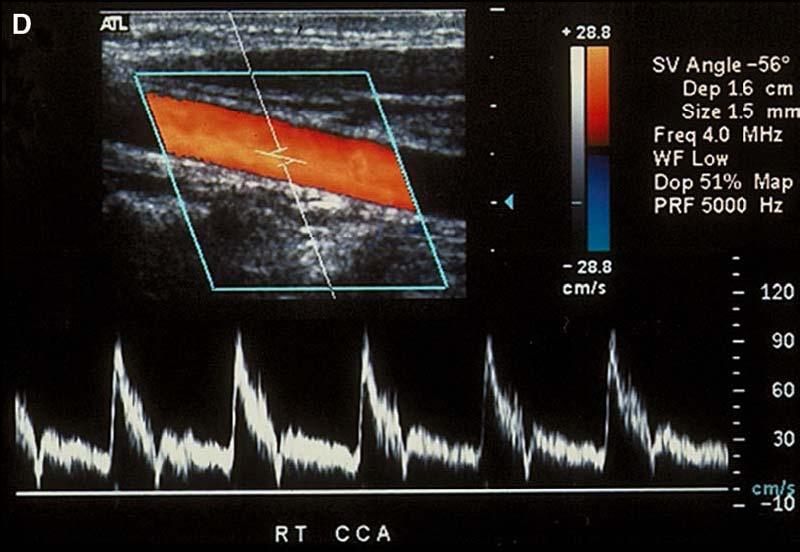 systolic upstroke and thin spectral envelope flow below the