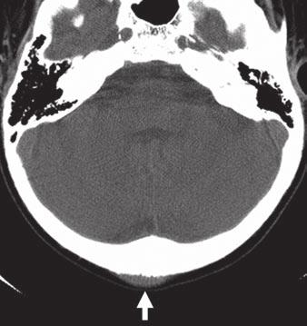 Craniofacial and intracranial manifestations of Langerhans cell histiocytosis: report of findings in 100 patients. JR 2008; 191:589 597 8. Matthay K, risse H, Couanet D, et al.