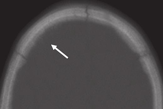 Primary cerebral neuroblastoma. JR-TR 2005; 88:148 149 10. Porto L, Keislich M, Yan, Schwabe D, Zanella Fig. 1 1-year-old boy with metastatic neuroblastoma.