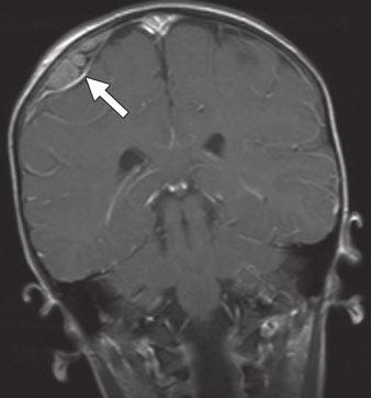 Neuropediatrics 2005; 36:112 116 11. Egelhoff JC, Zalles C. Unusual CNS presentation of neuroblastoma. Pediatr Radiol 1996; 26:51 54 12. Gallet L, Egelhoff JC.