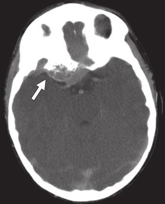 D mbrosio et al. Fig. 5 1-year-old girl with metastatic neuroblastoma.