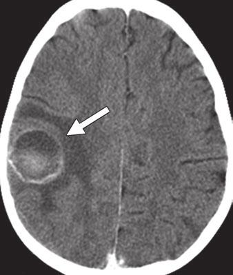 months., Initial CT scan obtained during staging is unremarkable.