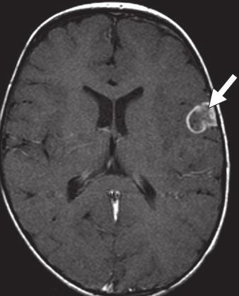 peripherally enhancing lesion (arrow), which was metastatic neuroblastoma,