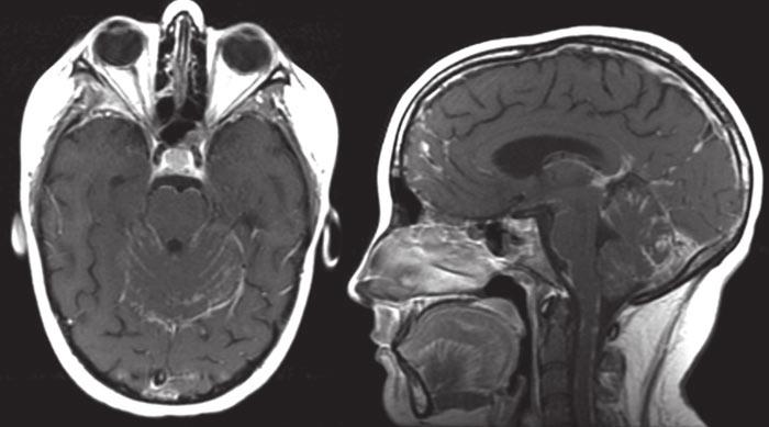 D mbrosio et al. Fig. 10 10-year-old girl with metastatic neuroblastoma.