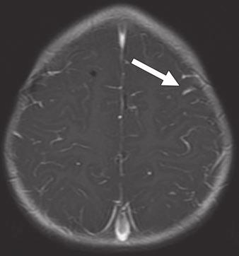 xial (left) and sagittal (right) contrast-enhanced T1-weighted images show diffuse leptomeningeal enhancement,