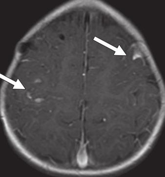 12 3-year-old girl with neuroblastoma and leptomeningeal metastases.