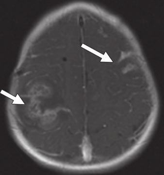 , Contrast-enhanced T1 image obtained 2 months after shows leptomeningeal enhancement has progressed over 2-month period.