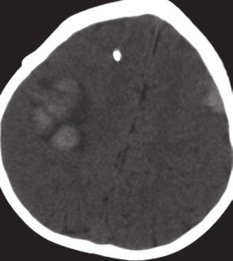 D and E, xial gradient-echo image (D) and unenhanced CT image (E) obtained shortly after and C show hemorrhagic transformation of leptomeningeal metastases.
