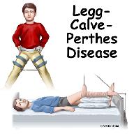 Introduction Perthes disease is a condition that affects the hip in children between the ages of four and eight.