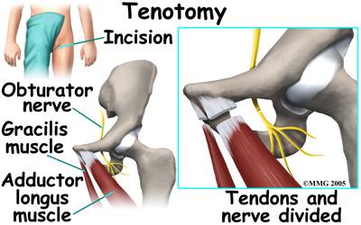 Realignment of the femur is called a femoral osteotomy. This procedure changes the angle of the femoral neck so that the femoral head points more towards the socket.