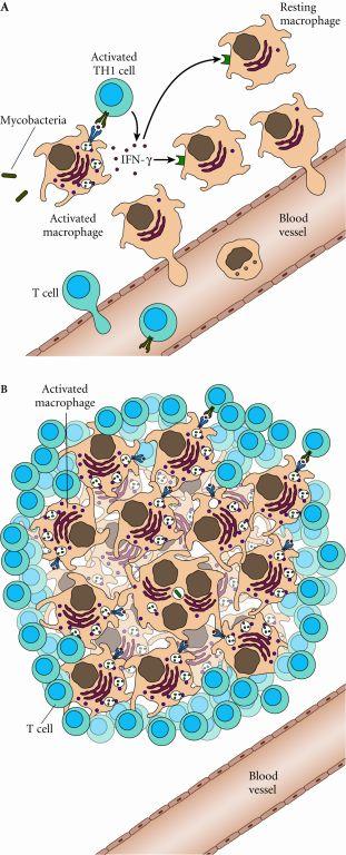 TH1 = Properly contained or tuberculoid infection The TH1 phenotype correlate with the less severe form of leprosy because TH1 cytokines recruit and activate macrophages Chemotactic cytokines recruit