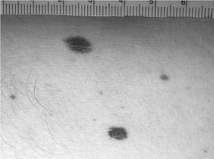 (size of pencil eraser) Size (>6mm), number (more than 50) and pattern (not in sun exposed sites)
