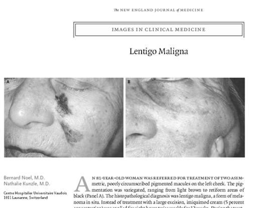 edu Melanoma and Imiquimod Reports in literature supporting treatment of LM with imiquimod Lentigo