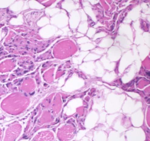 (28) IIT 16 (32) Presence of adipocytes (n, %) Rectus abdominis Control 4