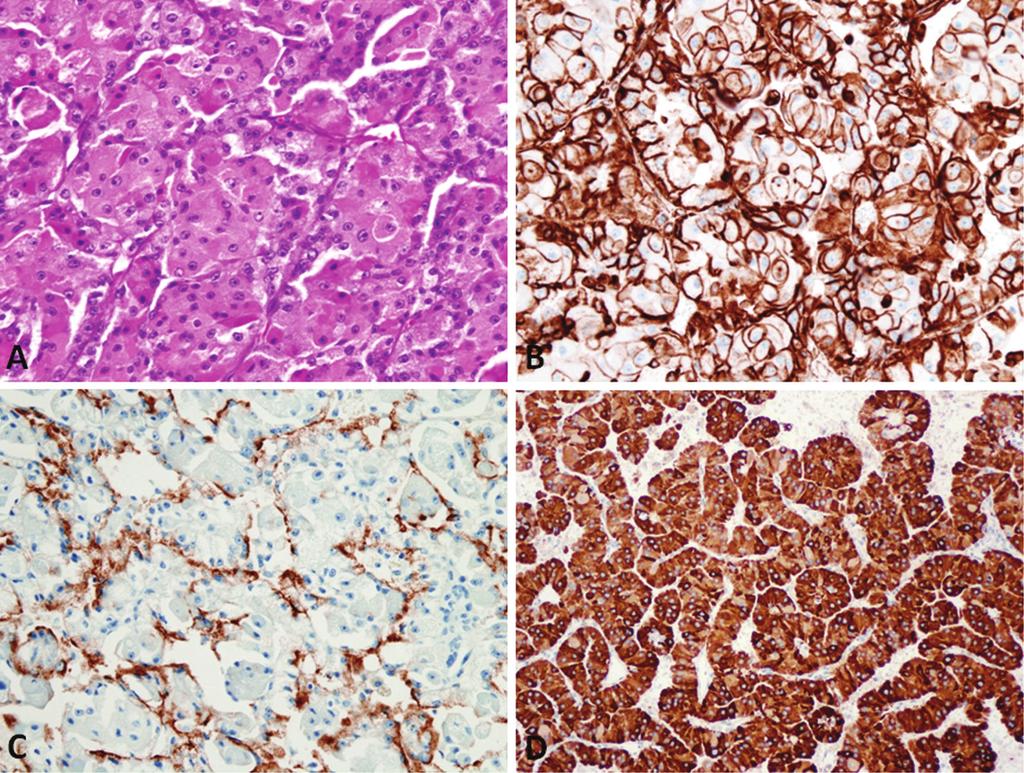 Figure 1. Application of immunohistochemical stains in the diagnosis of an oncocytic renal neoplasm.
