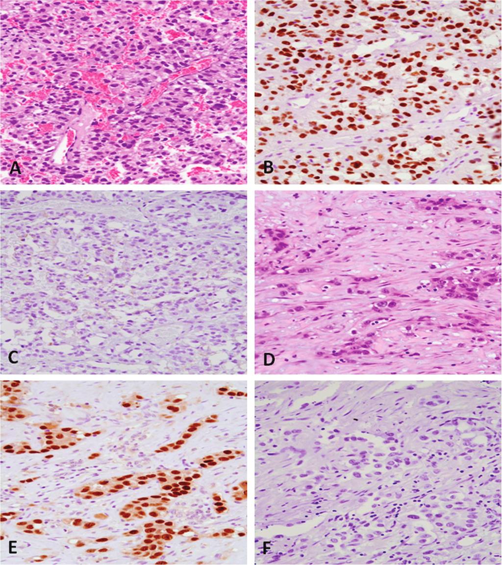 Figure 2. A through C, Immunohistochemical staining of metastatic renal cell carcinoma (RCC). A, Metastatic, high-grade clear cell RCC to the lung (hematoxylin-eosin staining).