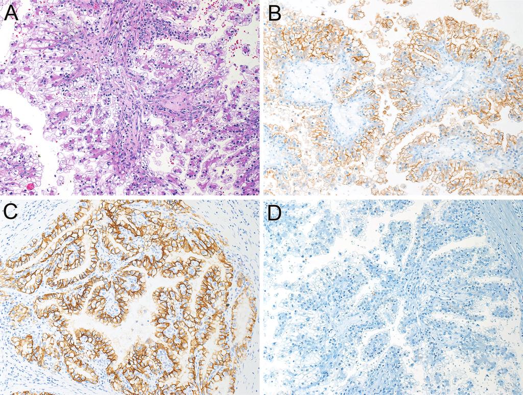 Figure 1. Clear cell renal cell carcinoma. A, True papillary formation with clear cells projecting into cystic spaces. B, Membranous CD10 labeling. C, Diffuse complete membranous CAIX labeling.