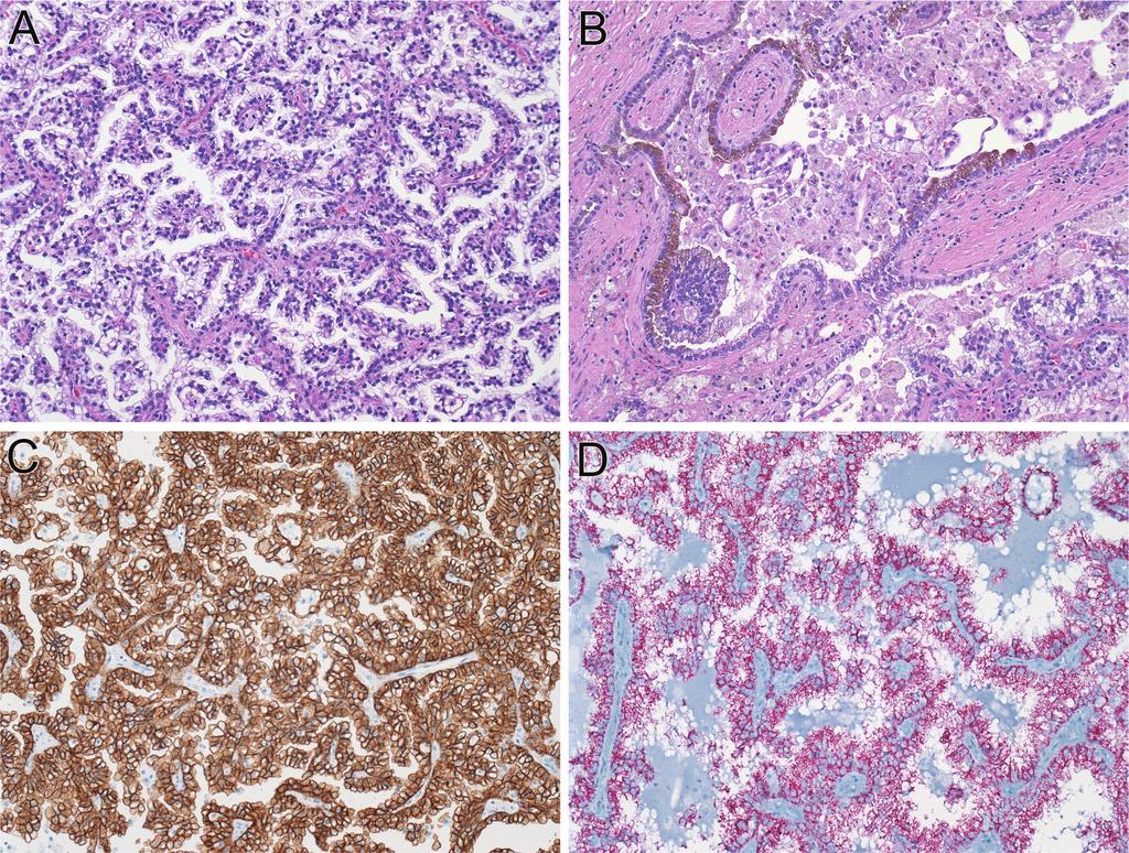 Figure. Papillary renal cell carcinoma. A, Delicate papillary fronds lined by clear cells. B, Foamy macrophages in fibrovascular cores and hemosiderin deposition in neoplastic epithelial cells.