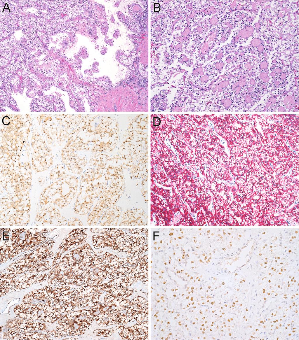 Figure 4. Xp11 translocation renal cell carcinoma. A, Papillary and nested architecture with clear to granular eosinophilic cytoplasm.