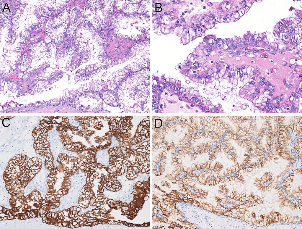 Clinical, Morphologic, Immunohistochemical, and Genetic Features Useful for Classifying Renal Cell Carcinomas (RCCs) With Clear Cells and Papillary Architecture Immunohistochemistry RCC Type Clinical