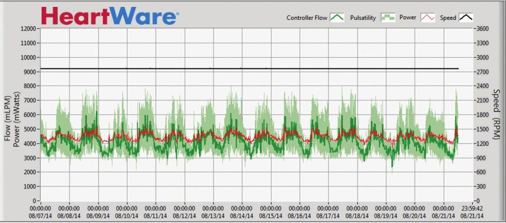 CONSISTENT PUMP PARAMETERS In this example, the patient s system has recorded regular and consistent power, flow, and pulsatility.