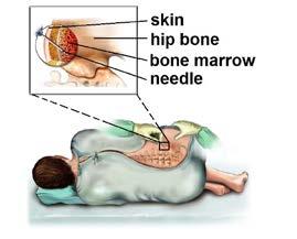 2 Testing for MDS Bone marrow biopsy and aspiration Bone marrow biopsy and aspiration To confirm MDS, a sample of bone marrow must be removed from your body for testing.