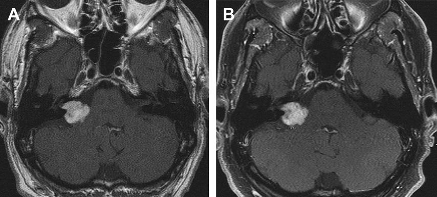 672 Sakamoto et al Fig. 5. (A) Axial T1 weighted gadolinium-enhanced MRI of a right-sided vestibular schwannoma before Cyberknife radiosurgery.